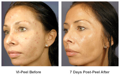 Before and after of 7 days post peel