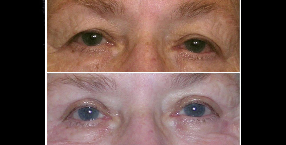 eyelid lift