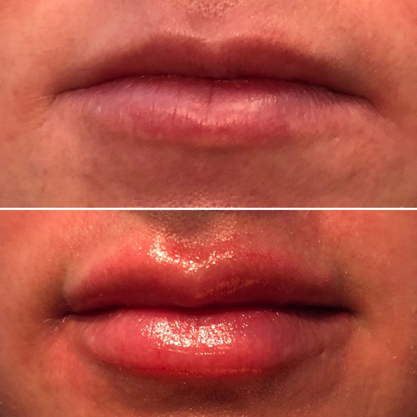 lips before and after