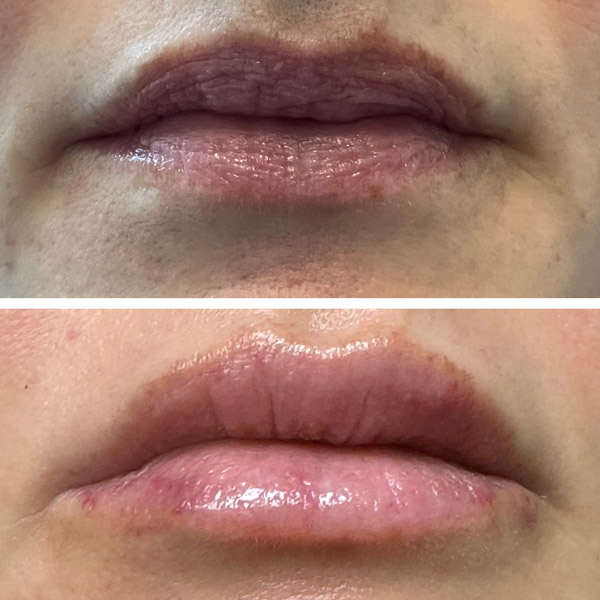 lips before and after