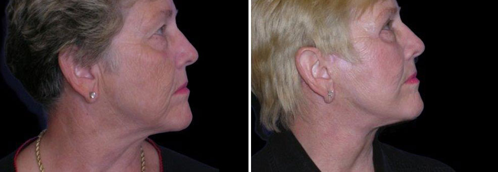 neck lift