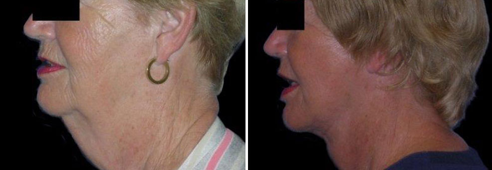 neck lift