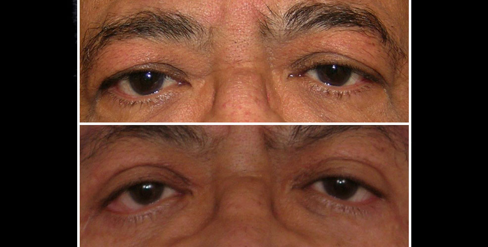 eyelid lift for men before and after