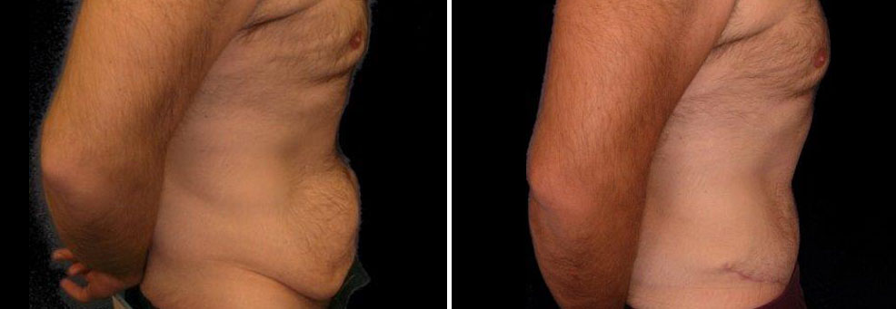 male tummy tuck before and after